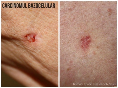 unde apare cancerul de piele suplimente de detoxifiere hepatică