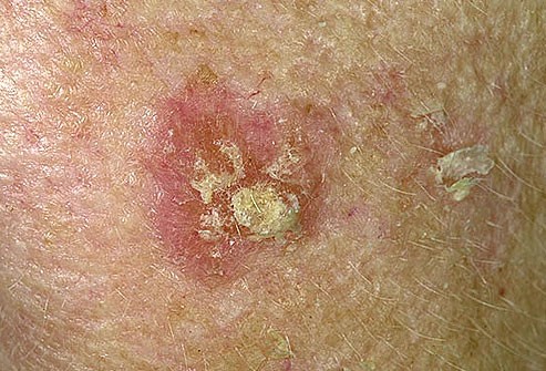 unde apare cancerul de piele