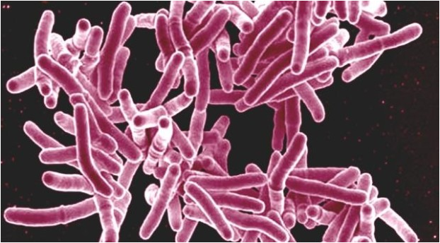 Tuberculoza: cauze de deces - Întrebări 